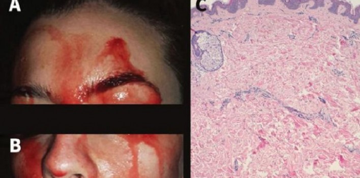 Una joven italiana de 21 años suda sangre en la cara y las manos